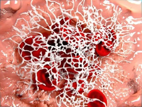 Nattokináz: 84% amyloid mikrokocsonya oldása 2 óra alatt!